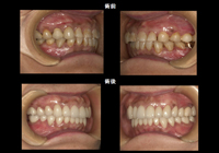 オールセラミック症例